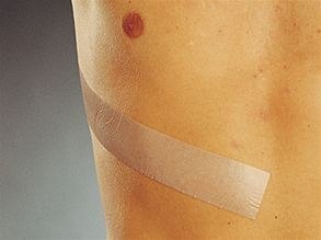 MÖLNLYCKE MEPIFORM 5 cm x 7,5 cm Samoprzylepny opatrunek na blizny, 5 szt.