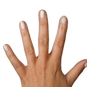 MÖLNLYCKE MEPITEL ONE 17 cm x 25 cm Opatrunek kontaktowy jednostronny, 5 szt.