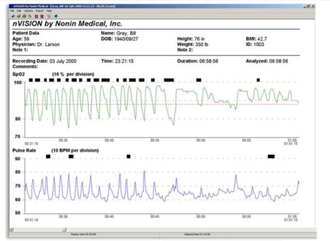 NONIN NVISION Oprogramowanie do zarządzania danymi SpO2, EtCO2, puls, analiza